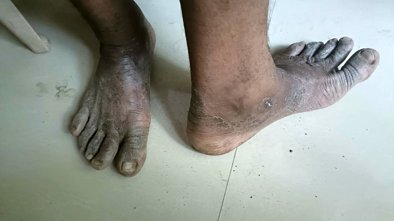 2023 06 Well Digging Case Survivor Feet 3 jpeg 202306 MUM Well Digging Rescue Approved for Full Use