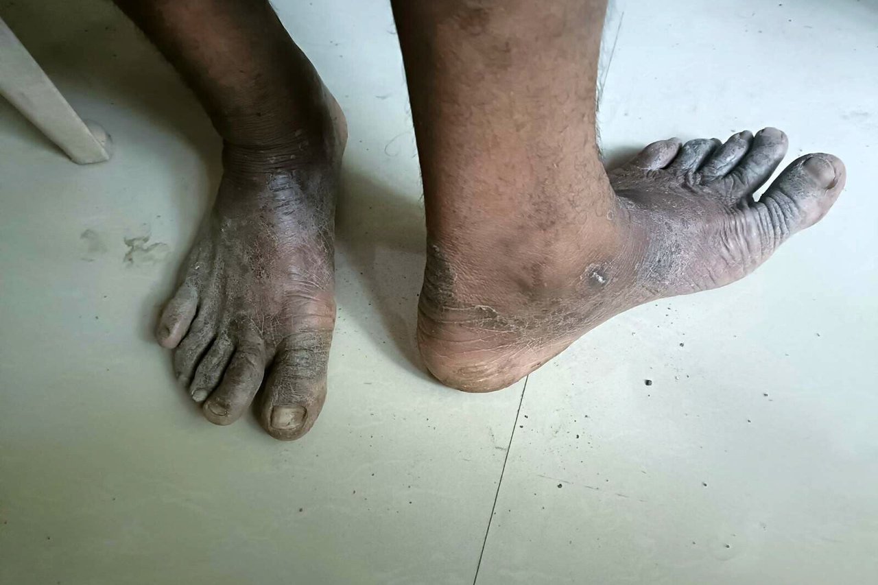 2023 06 Well Digging Case Survivor Feet 3 jpeg 202306 MUM Well Digging Rescue Approved for Full Use
